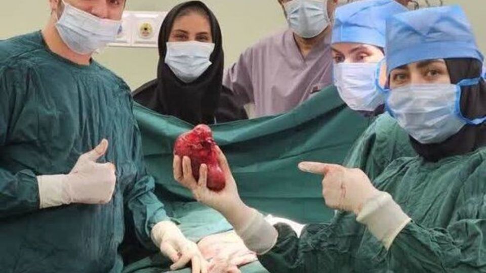 جراحی موفقیت آمیز تومور ۱۴ سانتی از کلیه کودک ۲ ساله